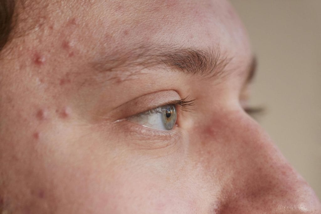 Perfil facial de pele acneica